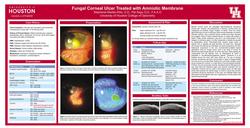 Fungal Corneal Ulcer Treated with Amniotic Membrane